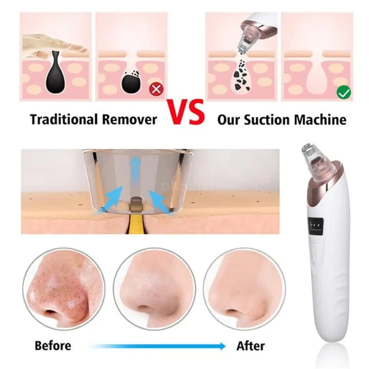 👉 Electric Blackhead Remover Vacuum for Deep Pore Cleansing